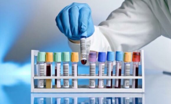 Blood Tests for Hair Loss