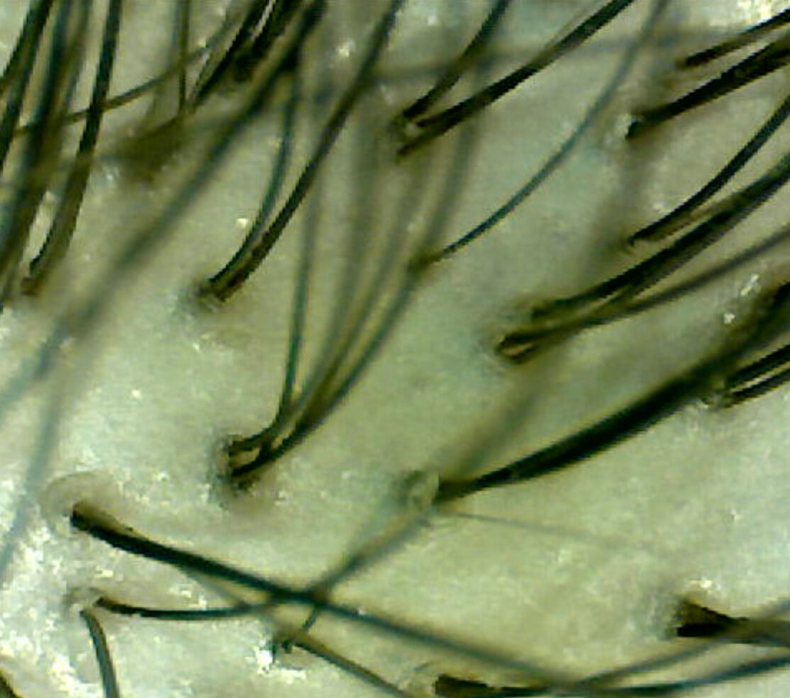 Hair Under The Microscope And Trichoscope Otter Valley Chiltern Hills Trichology Clinics